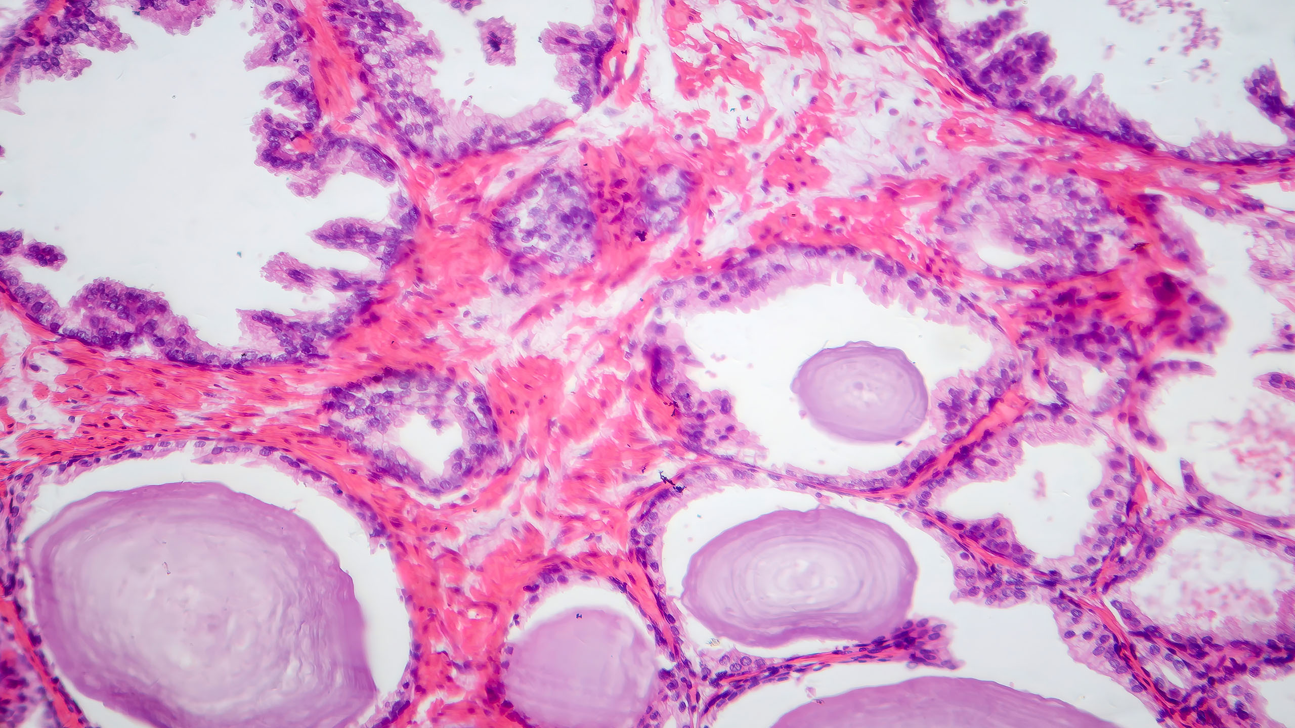 Urologenzentrum Wien - Gutartige Prostatavergrößerung (BPH): Mikroskopische Darstellung des Gewebes einer vergrößerten Prostata.